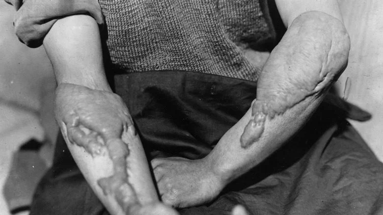 Un homme montre des cicatrices de brûlures par flash