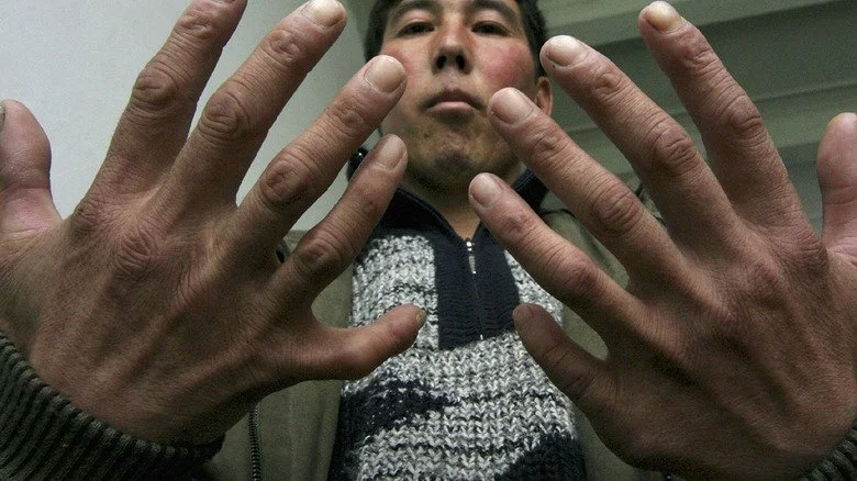 Homme avec doigts supplémentaires