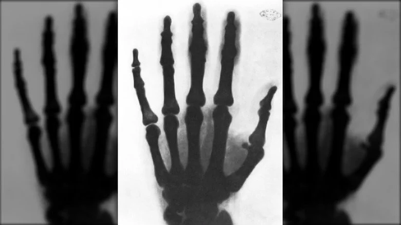 Radiographie de la main de Nikola Tesla
