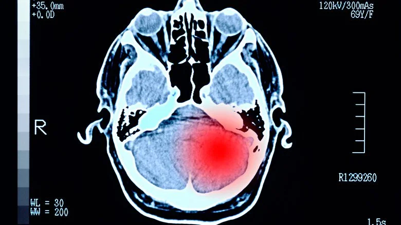 Image de dommages cérébraux