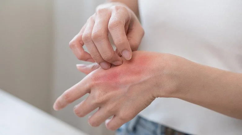 Peau rouge sur la main d'une femme