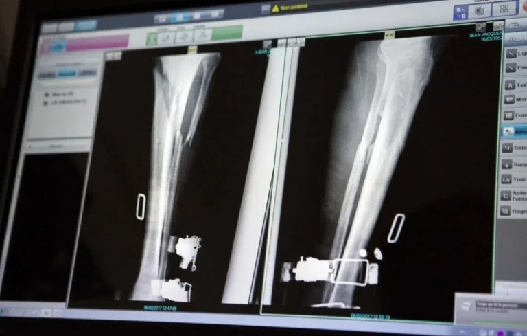 Erreur médicale à Lisieux : un retraité opéré des deux jambes