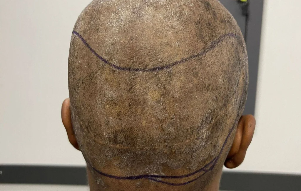 Un professeur britannique meurt lors d'une greffe de cheveux en Turquie