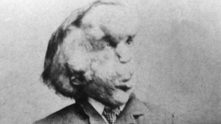 L&rsquo;Énigme de la Maladie de Joseph Merrick, l&rsquo;Homme Éléphant