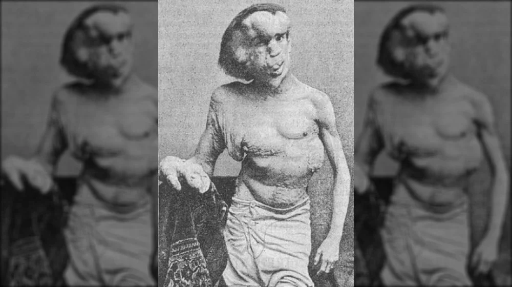 Joseph Merrick, portrait de 1889