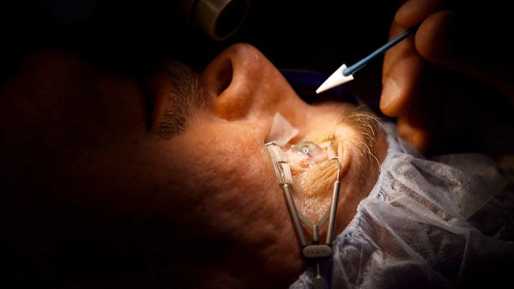 LASIK : Les Risques de la Chirurgie Réfractive Dévoilés