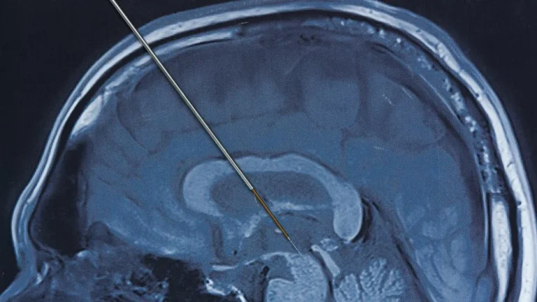 Implant cérébral : un scientifique lutte contre l&rsquo;alcoolisme