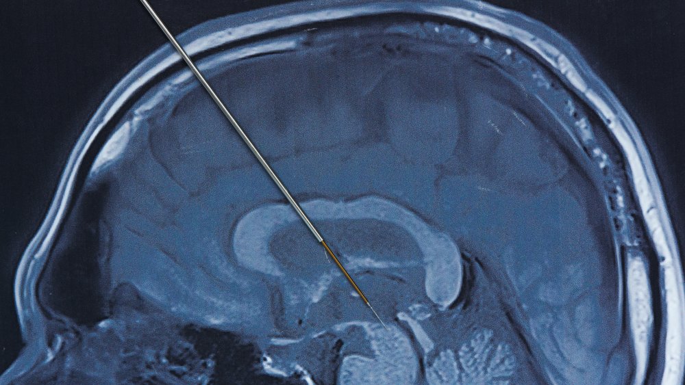 Aiguille dans le cerveau