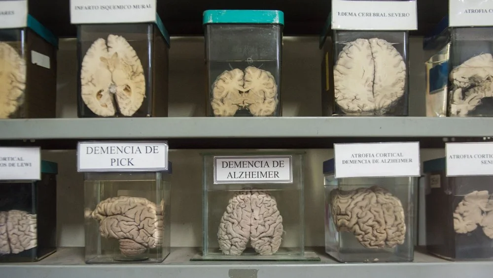 Combien de temps peut-on survivre sans cerveau ?