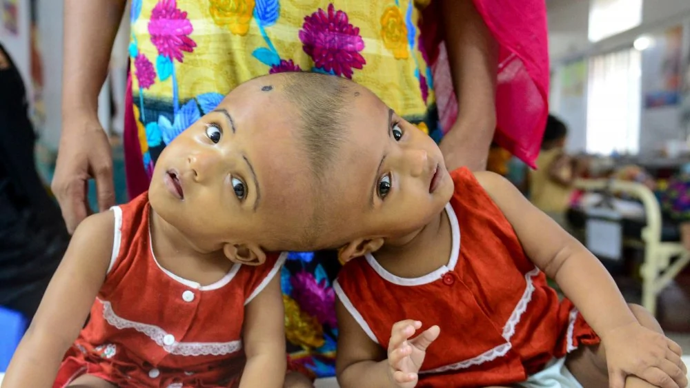 La vie des jumeaux siamois : défis et réalités