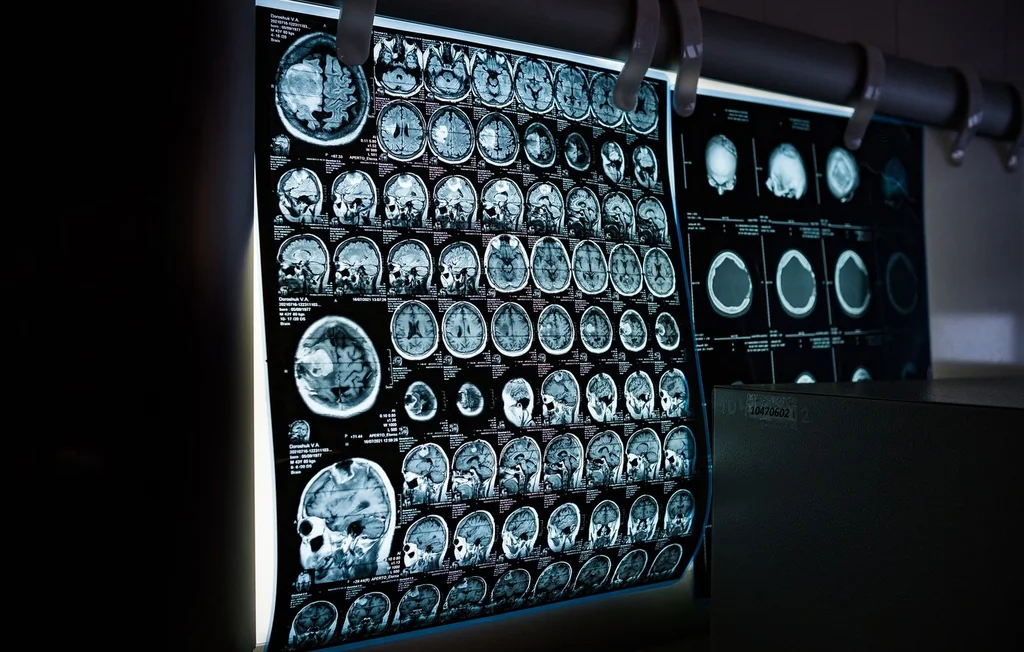 Royaume-Uni : Une épidémie de méningite mortelle frappe le Kent